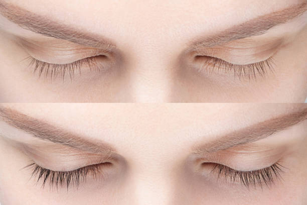 Natural eyelash transplant result