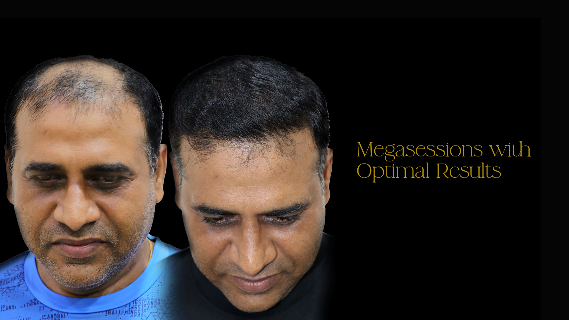 Hair Transplant Cost in Shirdi 2