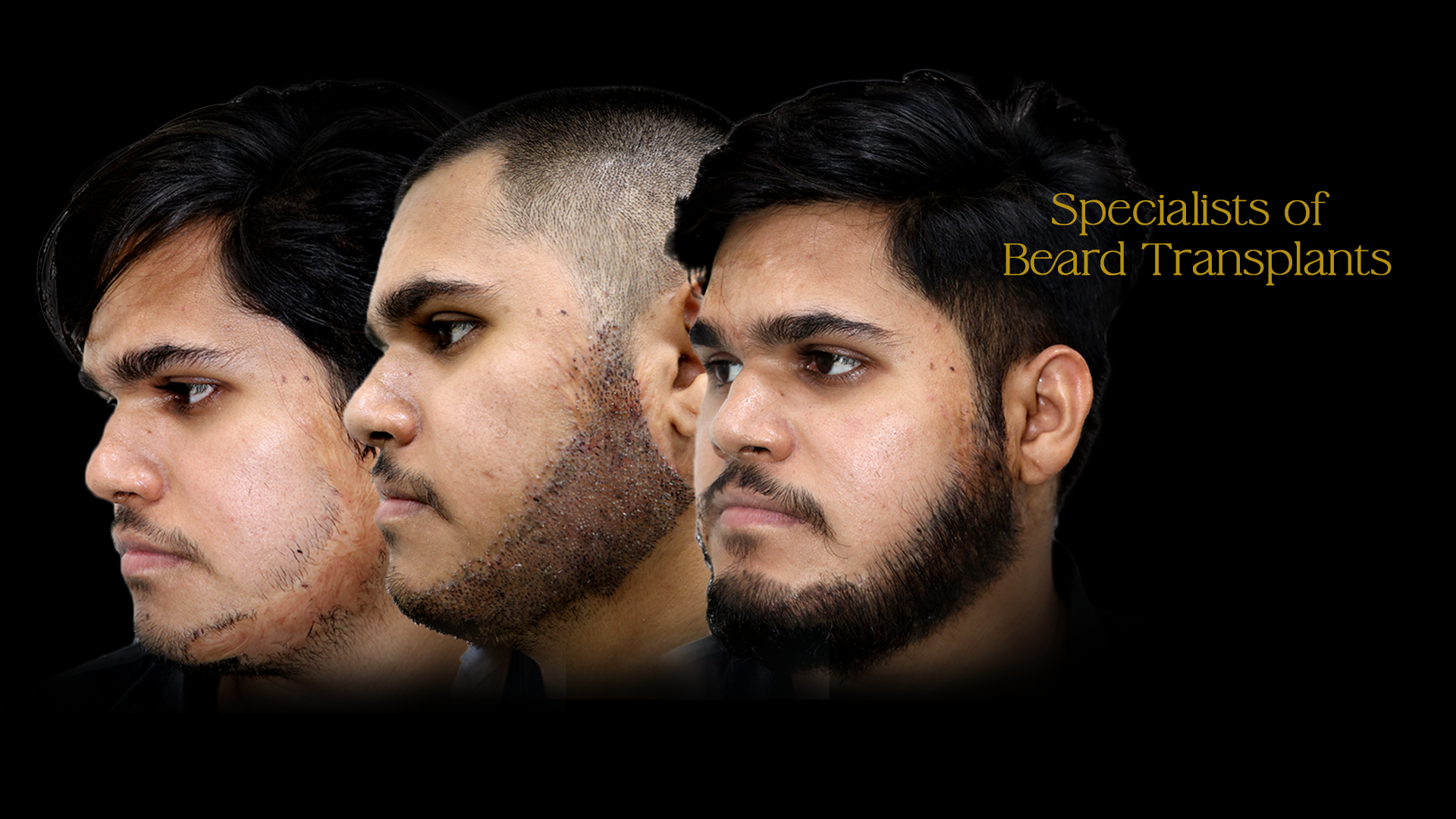 Hair Transplant Cost in Shirdi 3