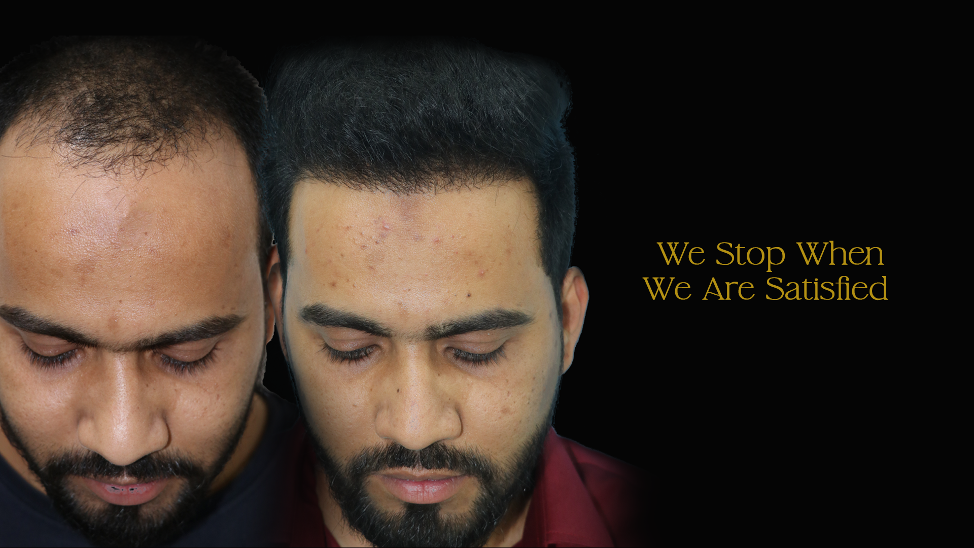 Hair Transplant Cost in Shirdi 4