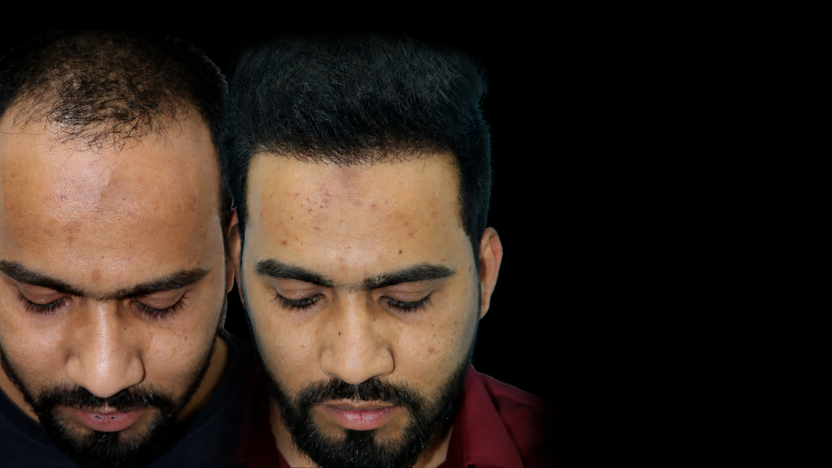 Hair Transplant Surgery in Shirdi