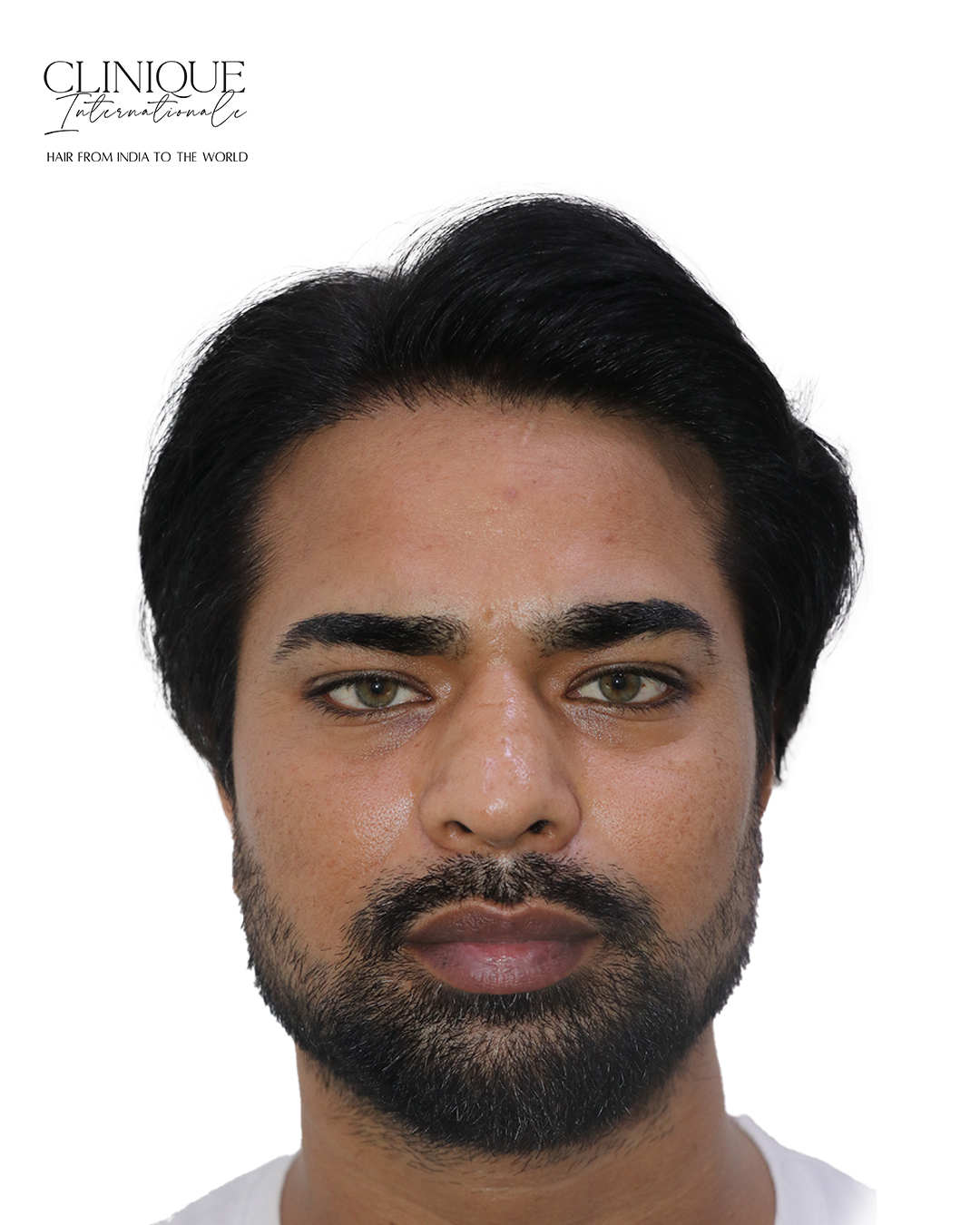 Patient after hair transplant