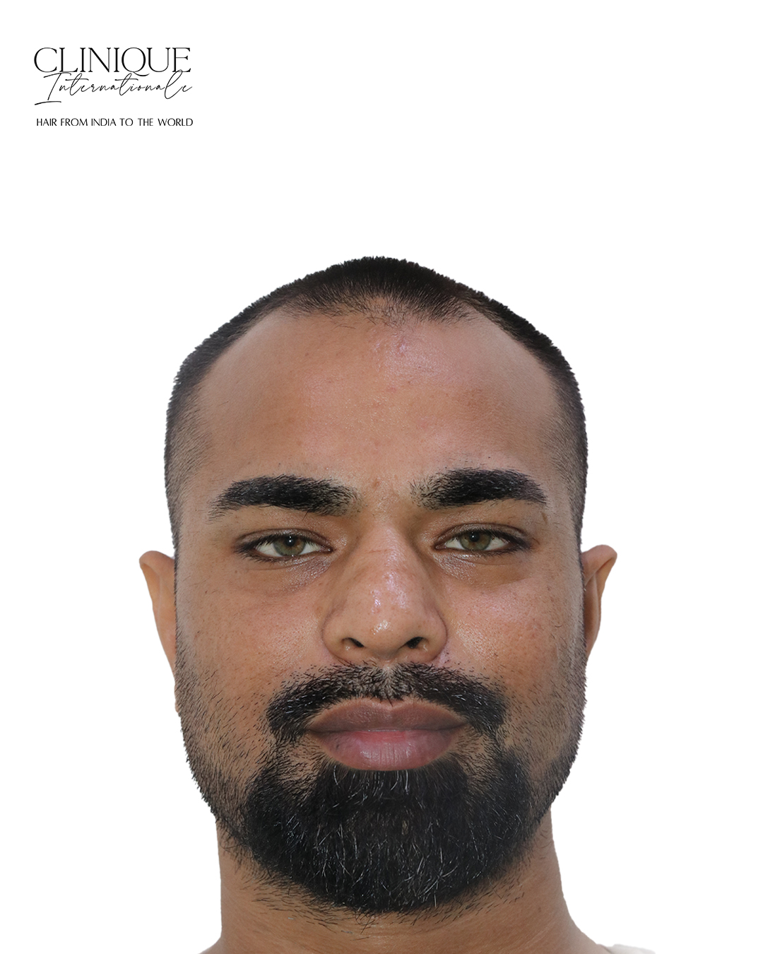 Patient before hair transplant