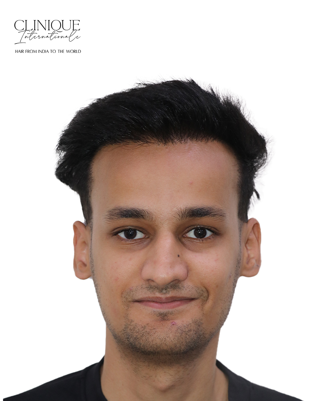 Patient after hair transplant
