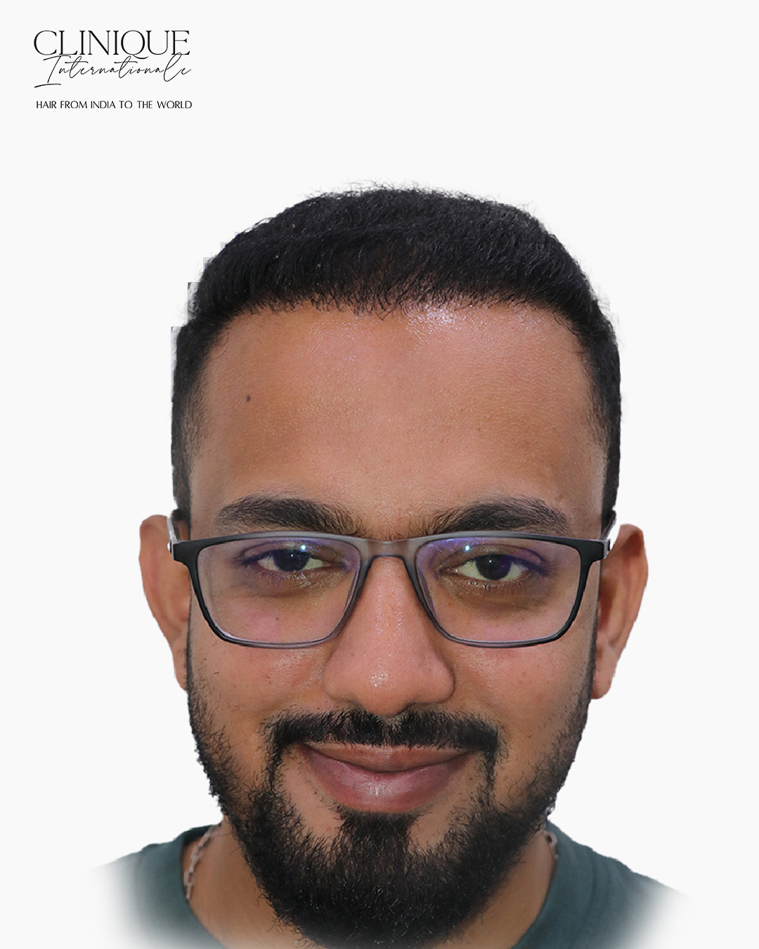 Akhil Mahajan after hair transplant