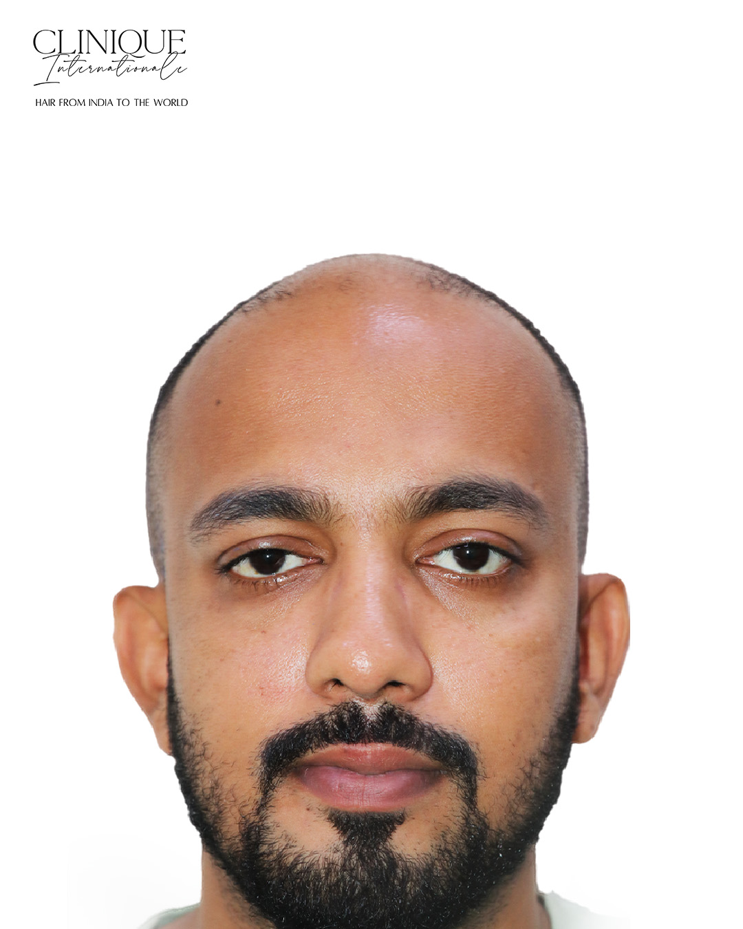 Akhil Mahajan before hair transplant