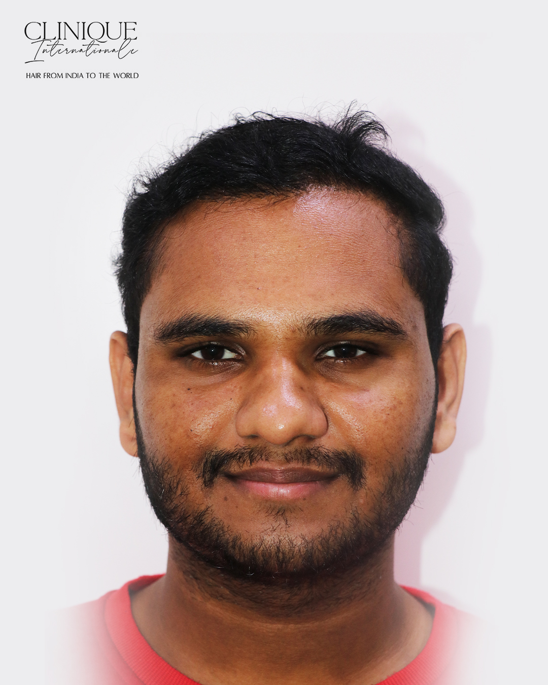 Azad after hair transplant